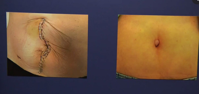 Surgery without (left) and with Dr. Greg Marchand’s Technique.